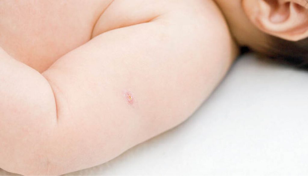 vacina bcg 1 1024x586