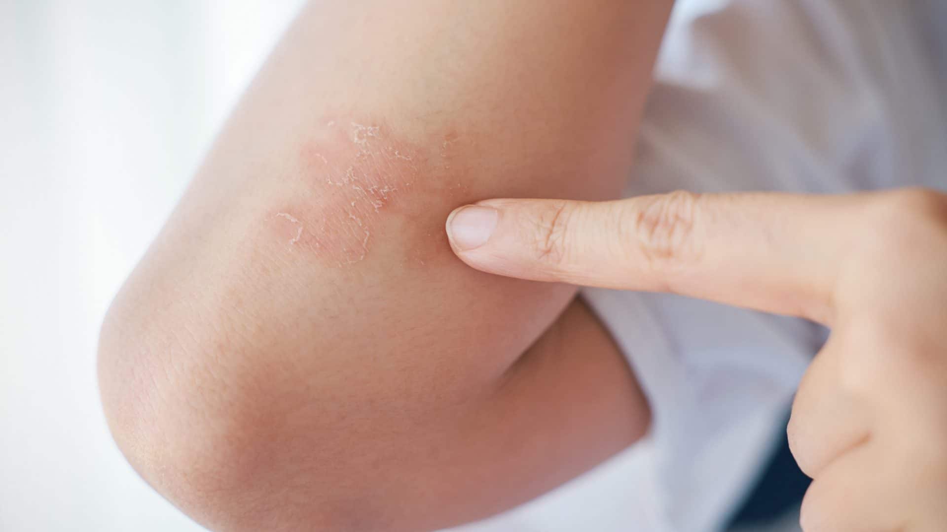 psoriasis 1 1920x1080